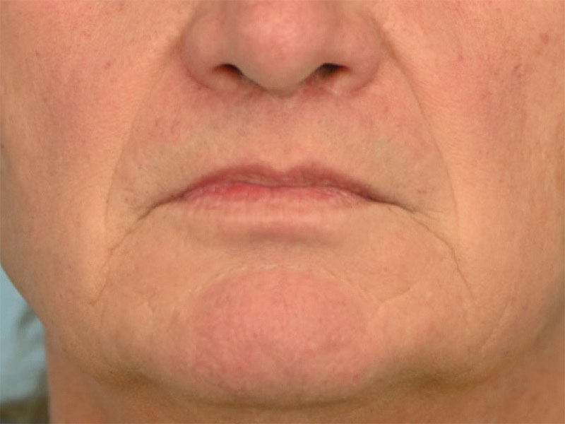 Lip Lift Before & After Image