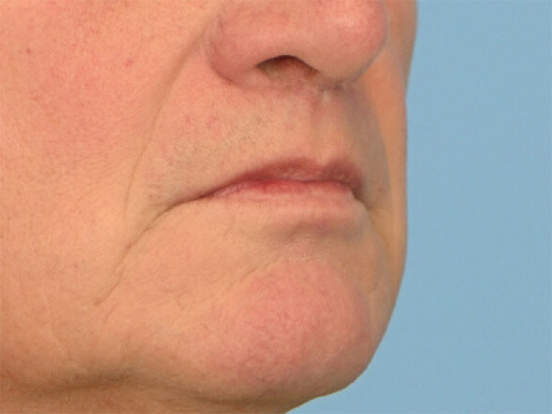 Lip Lift Before & After Image