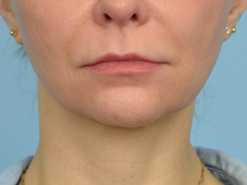 Lip Lift Before & After Image