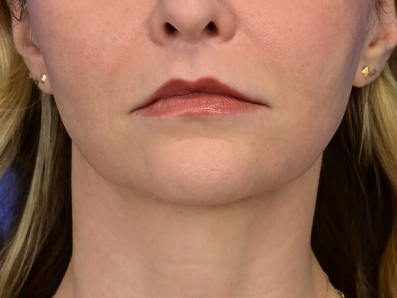 Lip Lift Before & After Image