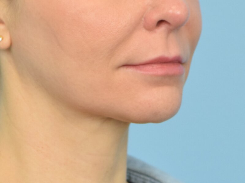 Lip Lift Before & After Image