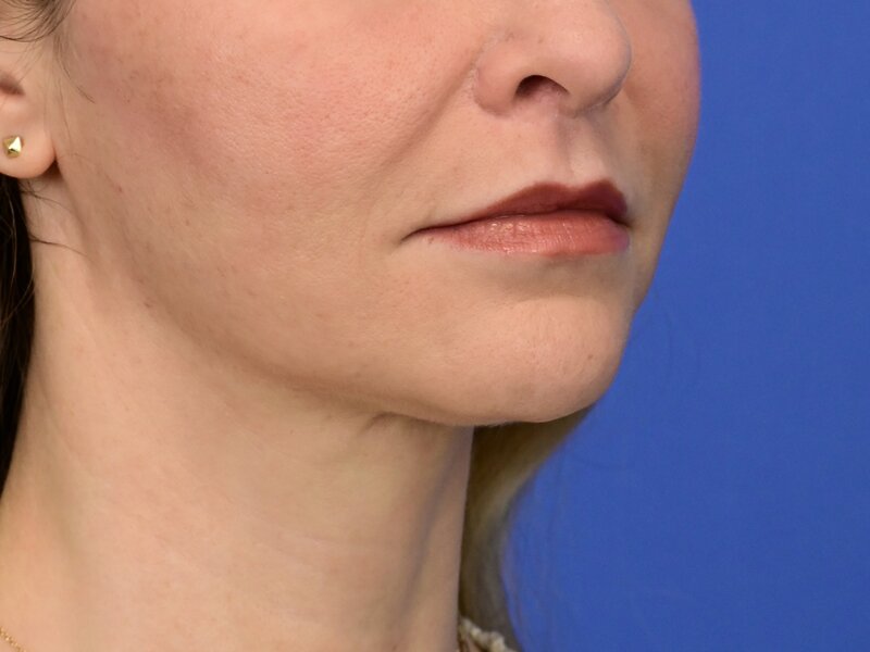 Lip Lift Before & After Image