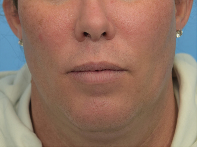 Lip Lift Before & After Image