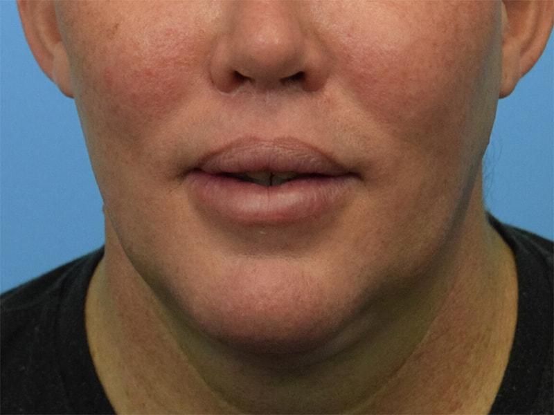 Lip Lift Before & After Image