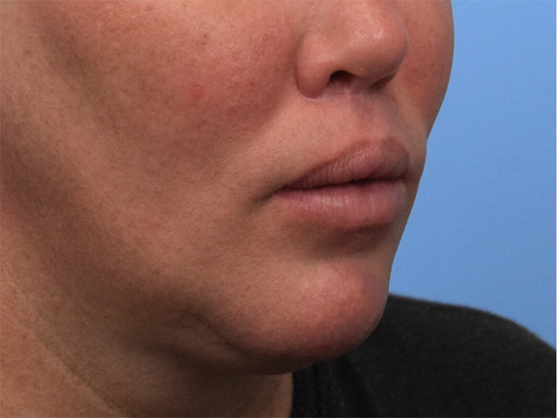 Lip Lift Before & After Image