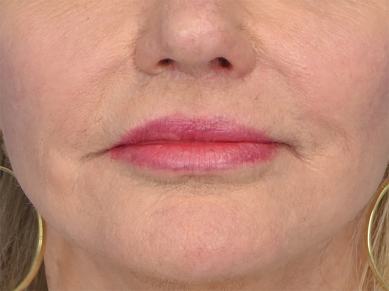 Lip Lift Before & After Image