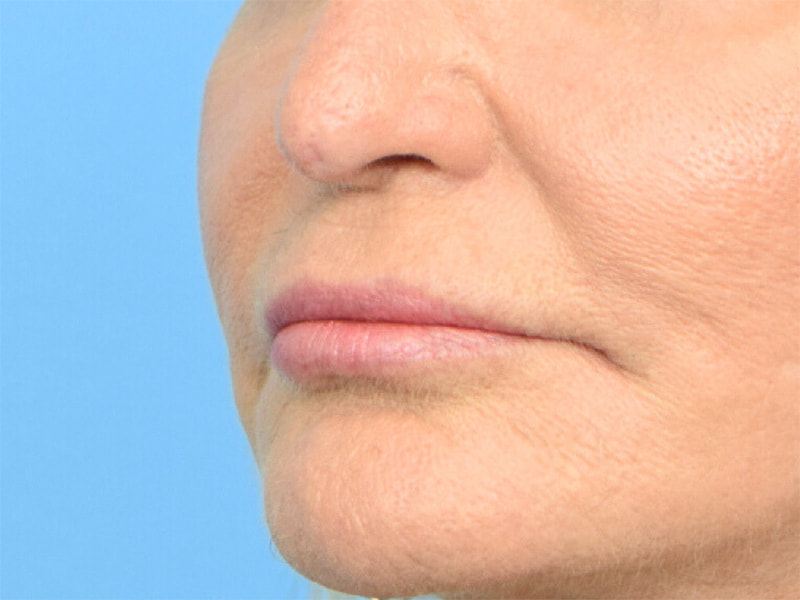 Lip Lift Before & After Image