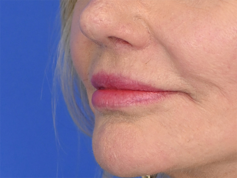 Lip Lift Before & After Image