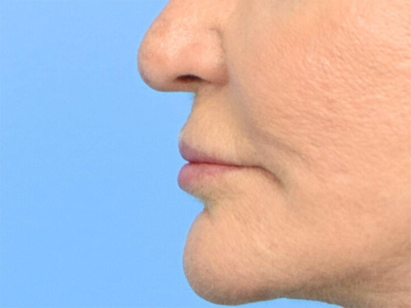 Lip Lift Before & After Image