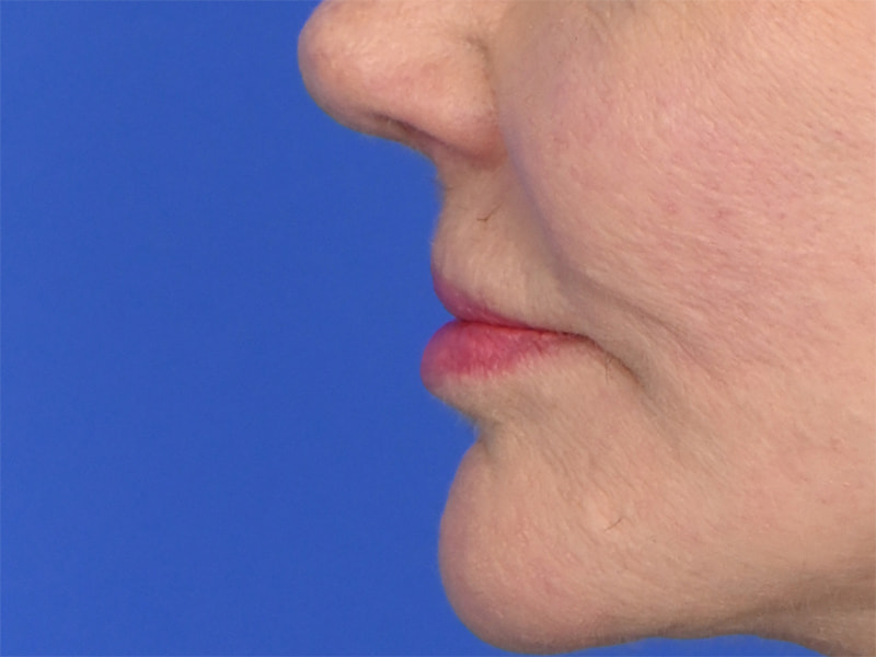 Lip Lift Before & After Image