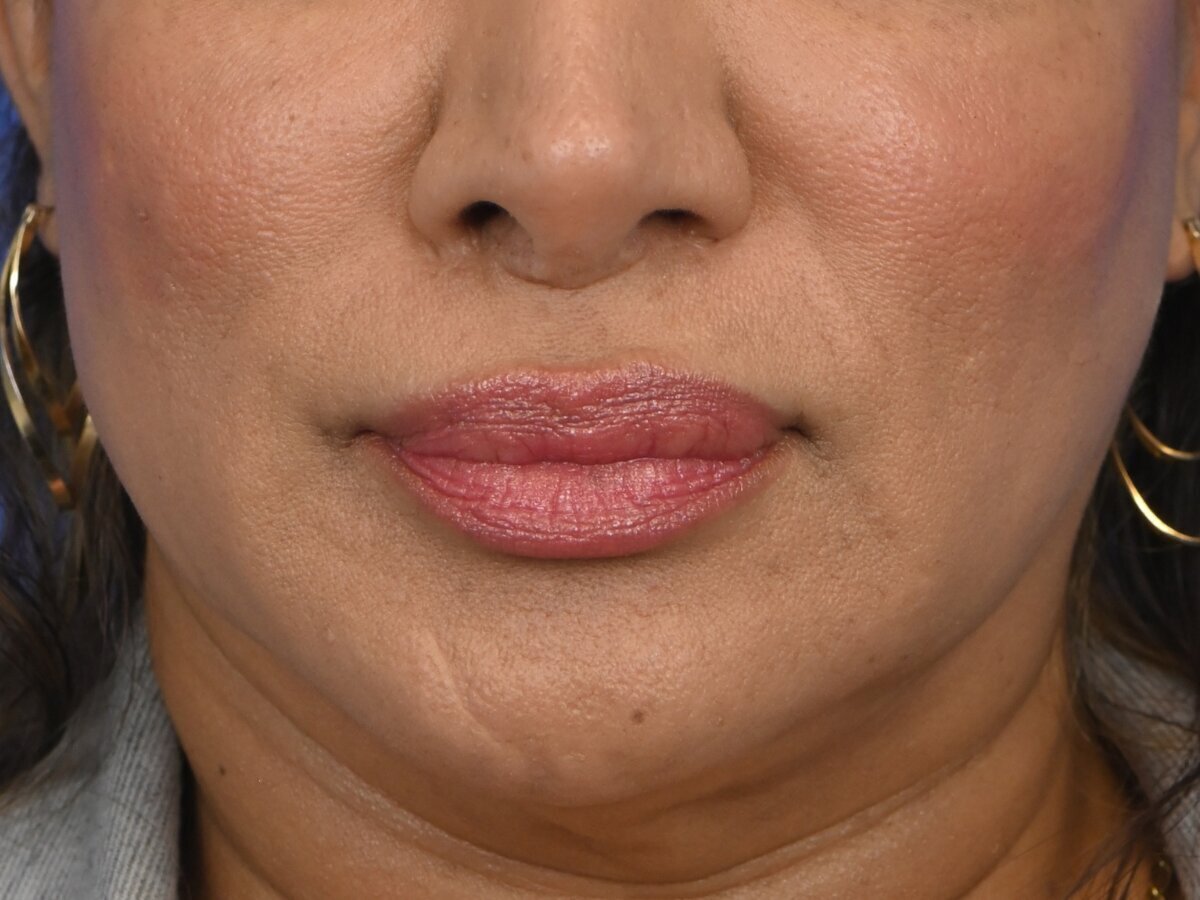 Lip Lift Before & After Image