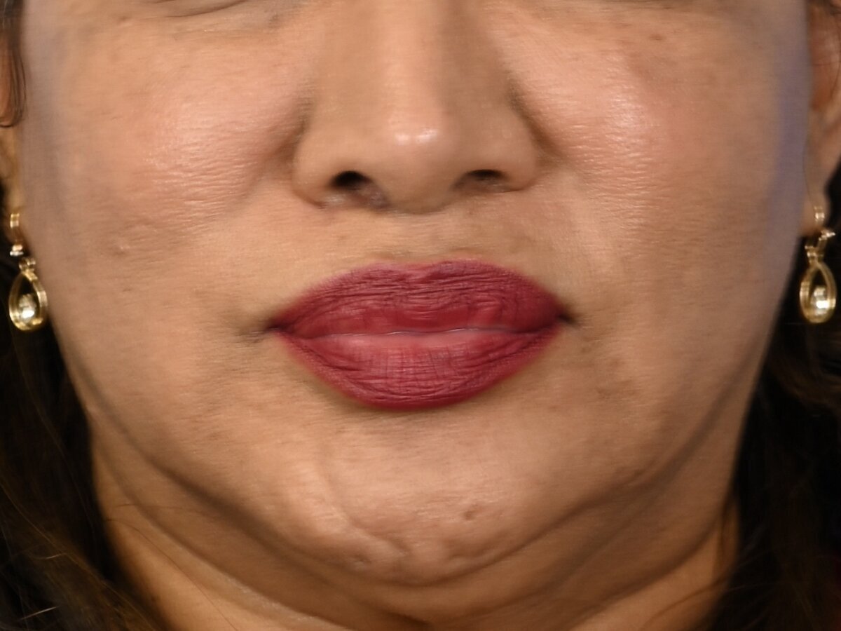 Lip Lift Before & After Image