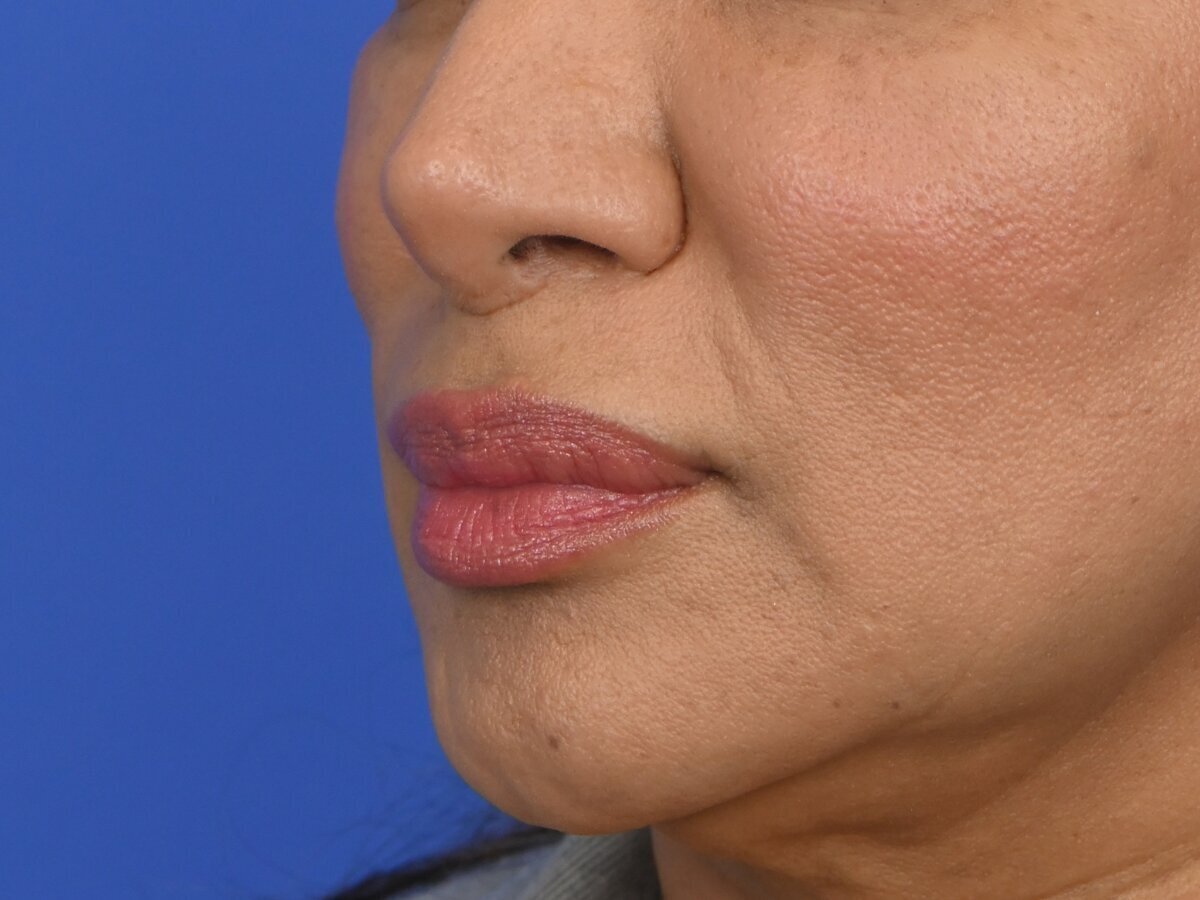 Lip Lift Before & After Image