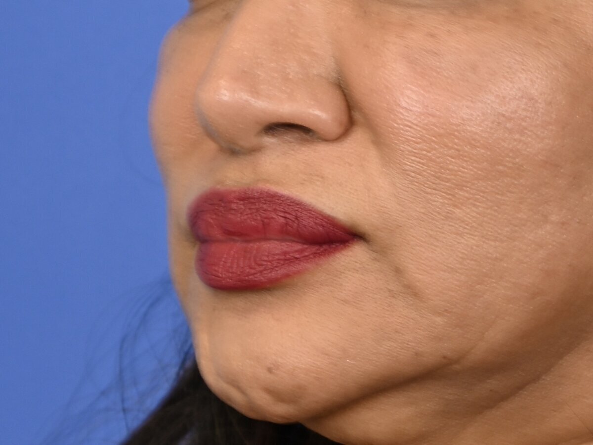 Lip Lift Before & After Image
