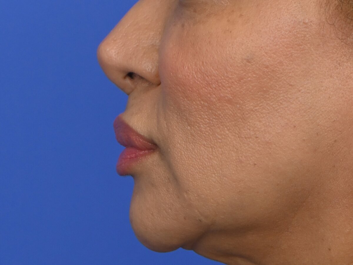 Lip Lift Before & After Image