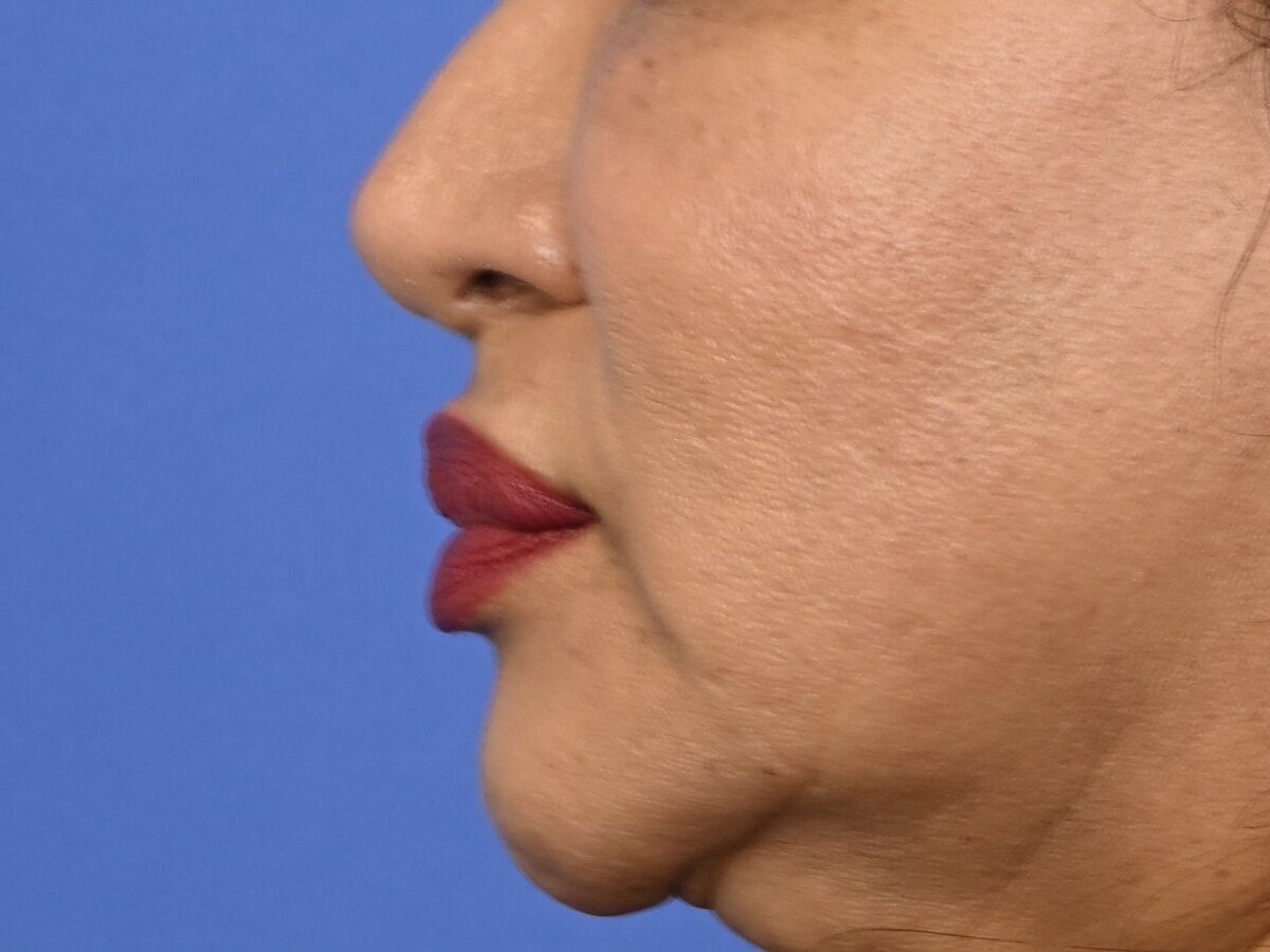 Lip Lift Before & After Image