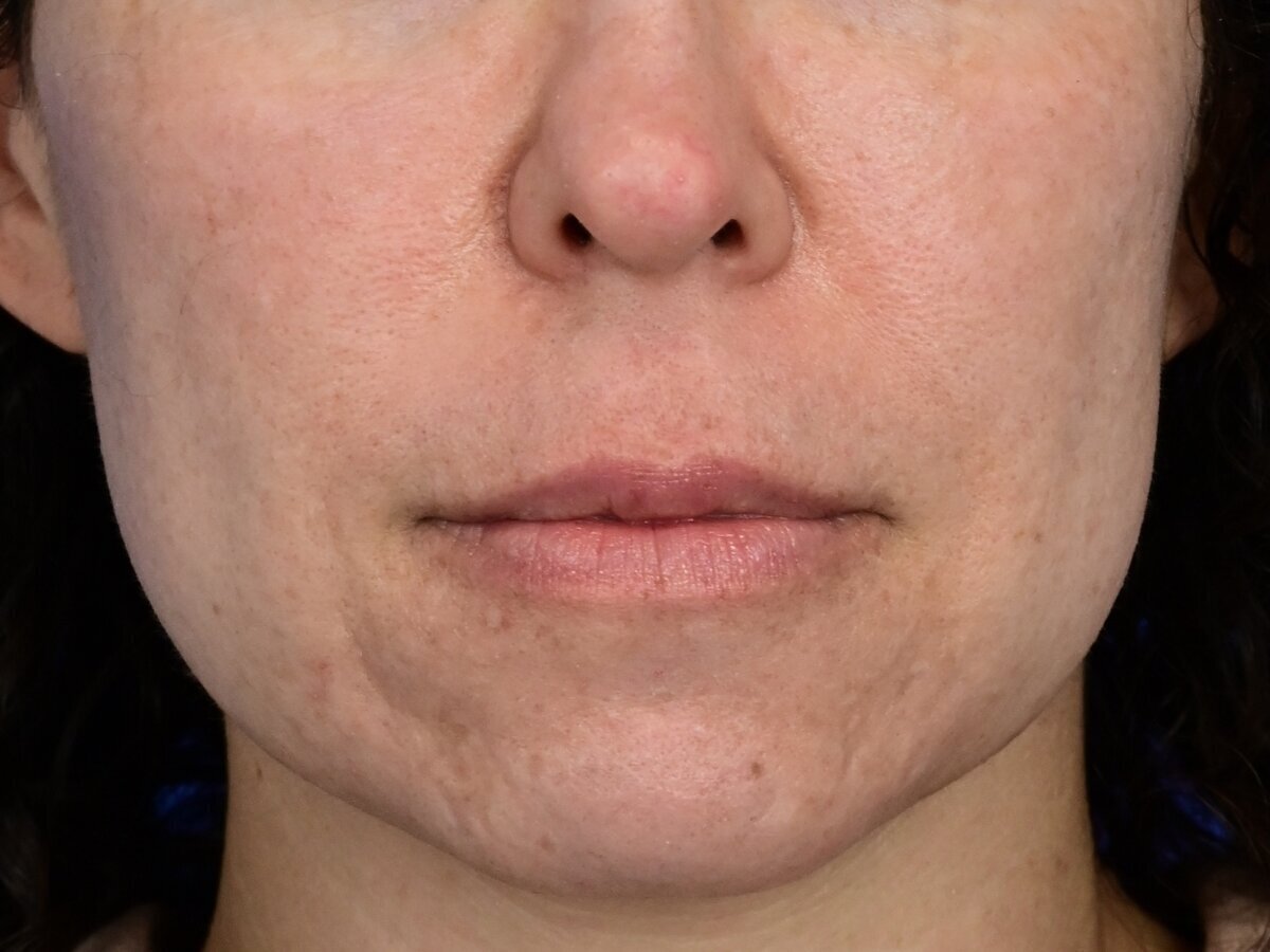 Lip Lift Before & After Image