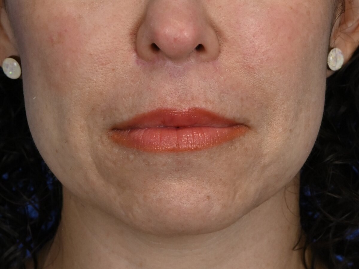 Lip Lift Before & After Image