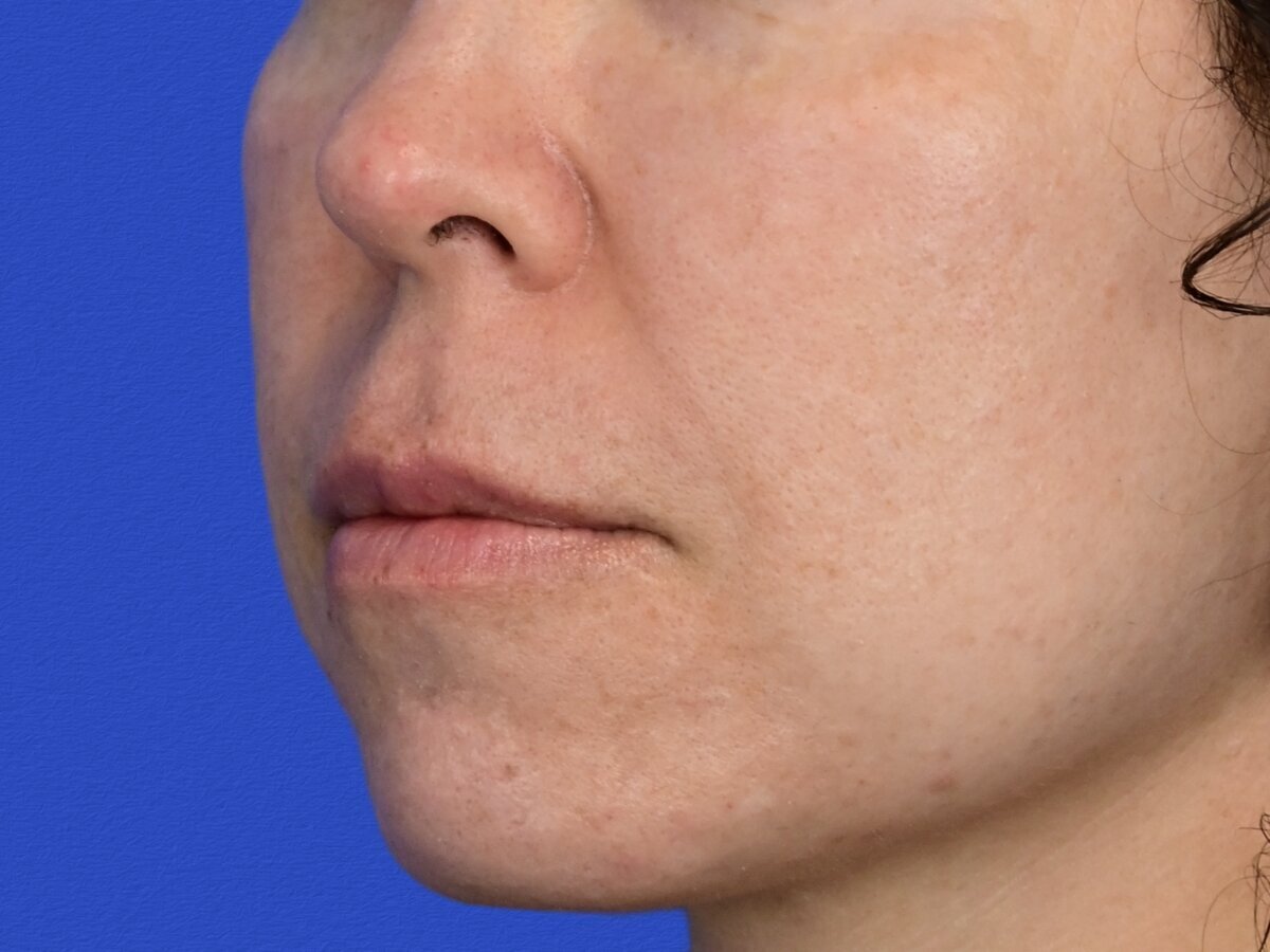 Lip Lift Before & After Image