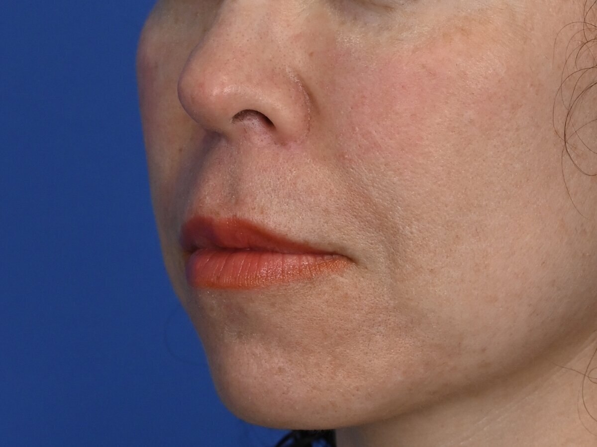 Lip Lift Before & After Image