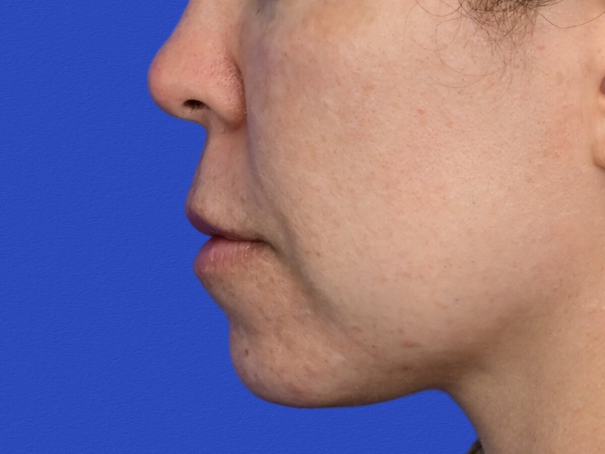 Lip Lift Before & After Image
