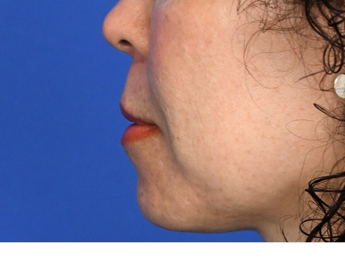 Lip Lift Before & After Image