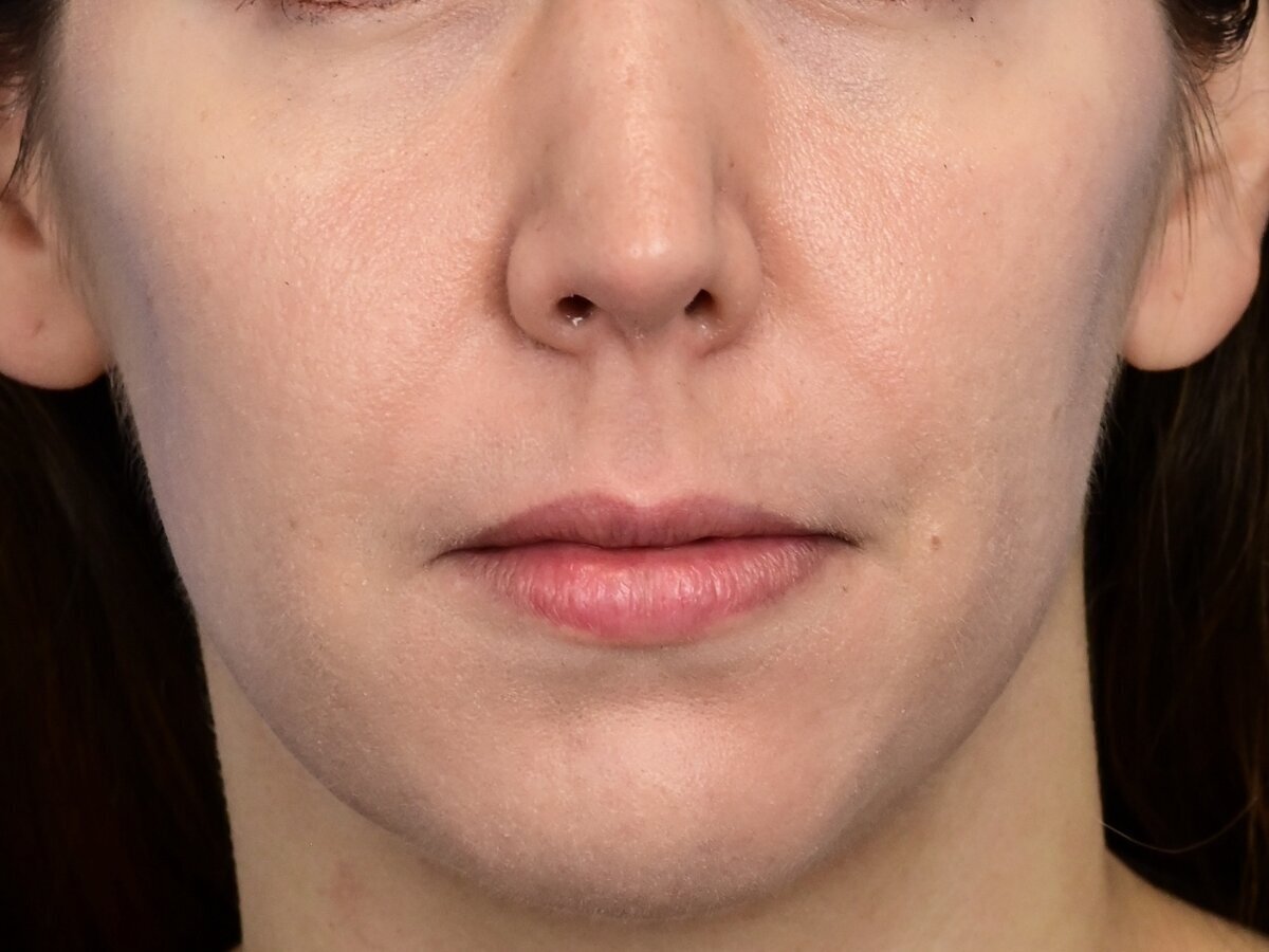 Lip Lift Before & After Image