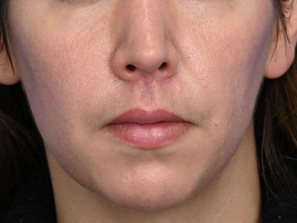 Lip Lift Before & After Image