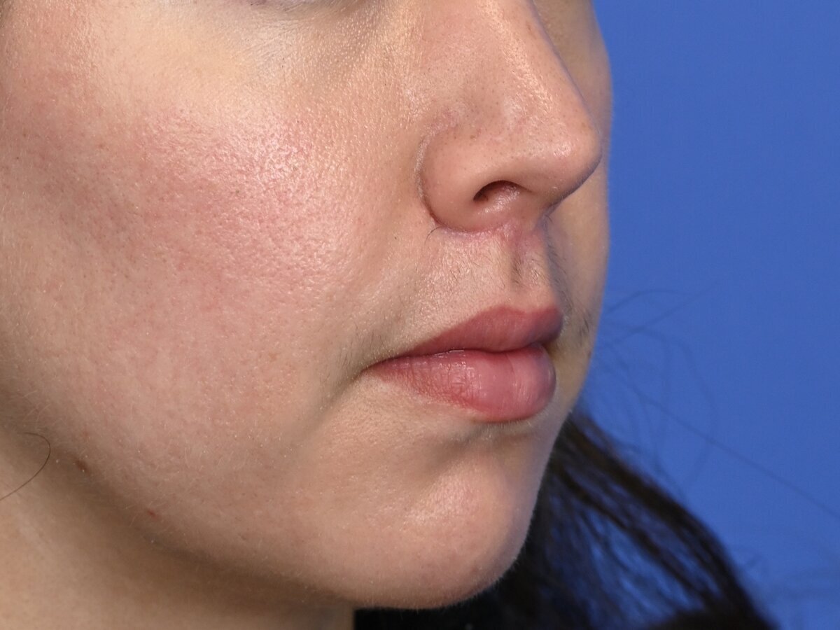 Lip Lift Before & After Image