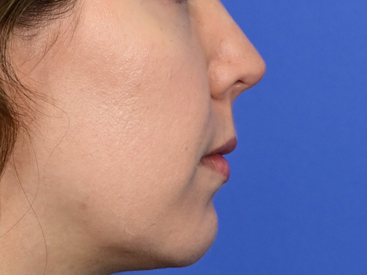 Lip Lift Before & After Image