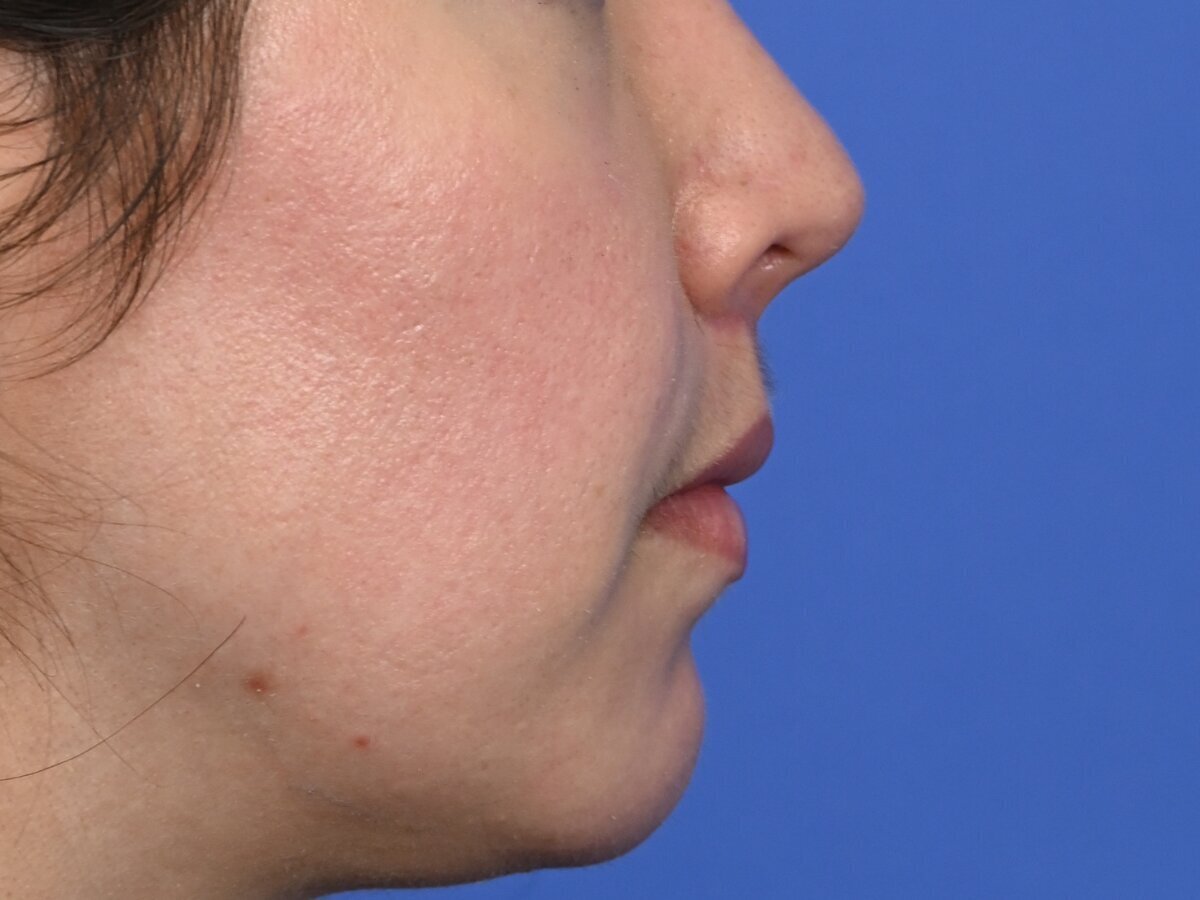 Lip Lift Before & After Image