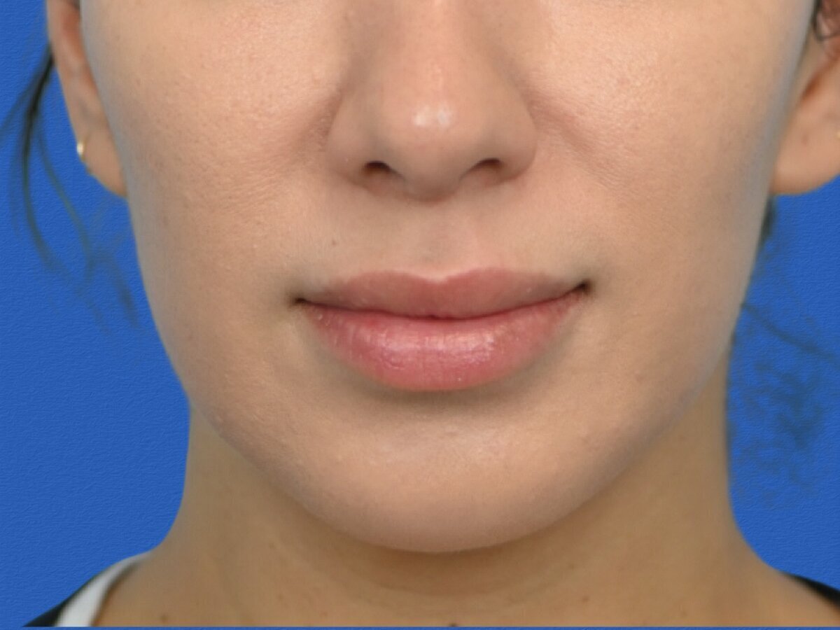 Lip Lift Before & After Image