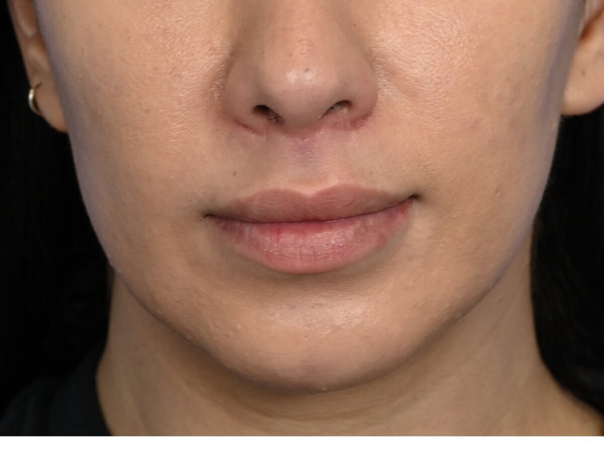 Lip Lift Before & After Image