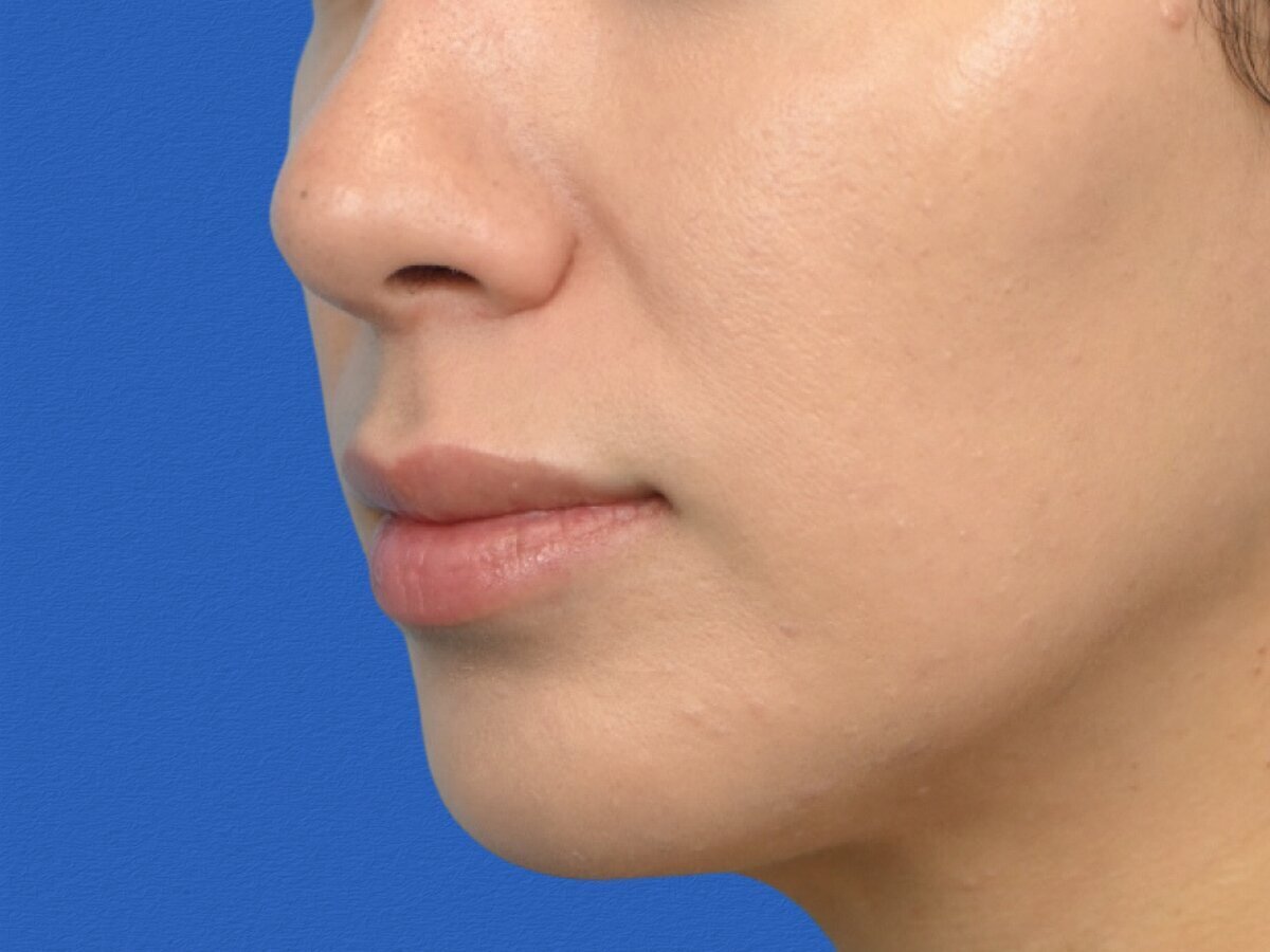 Lip Lift Before & After Image