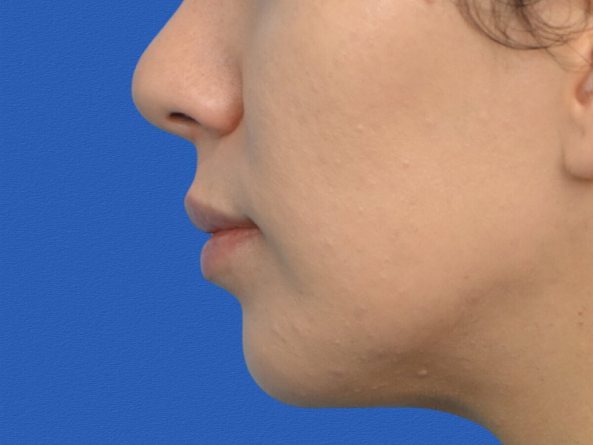Lip Lift Before & After Image