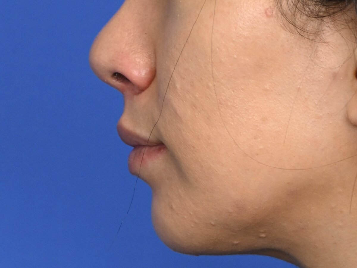 Lip Lift Before & After Image