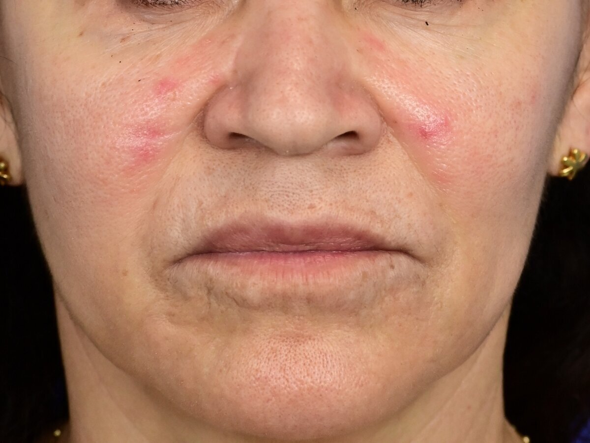 Lip Lift Before & After Image