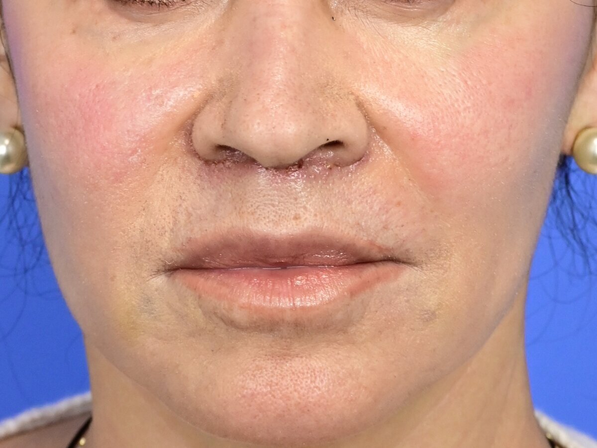 Lip Lift Before & After Image