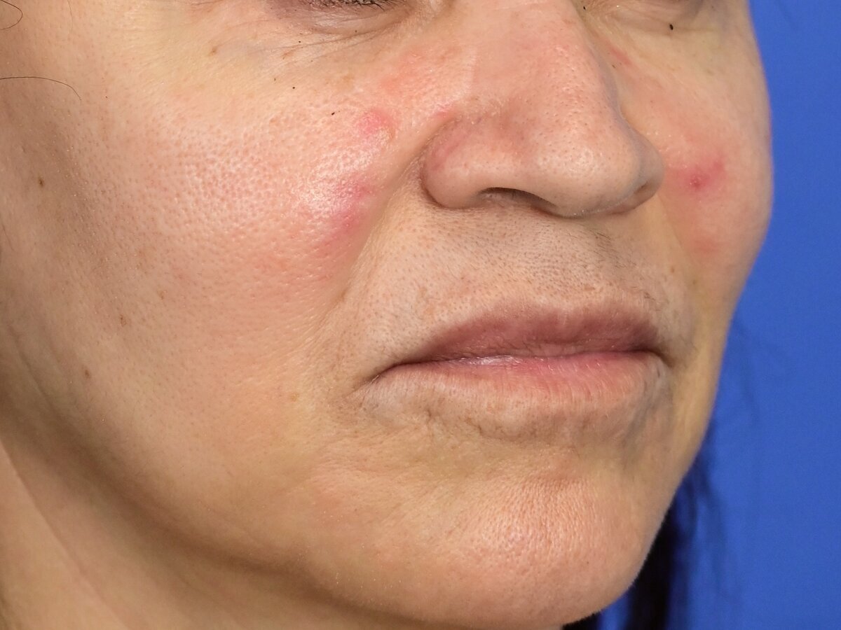 Lip Lift Before & After Image