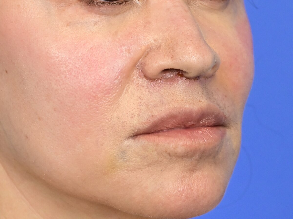 Lip Lift Before & After Image