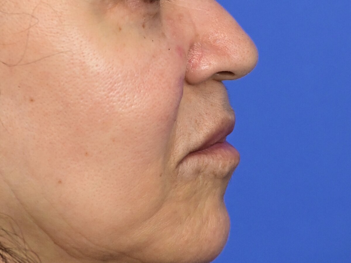 Lip Lift Before & After Image