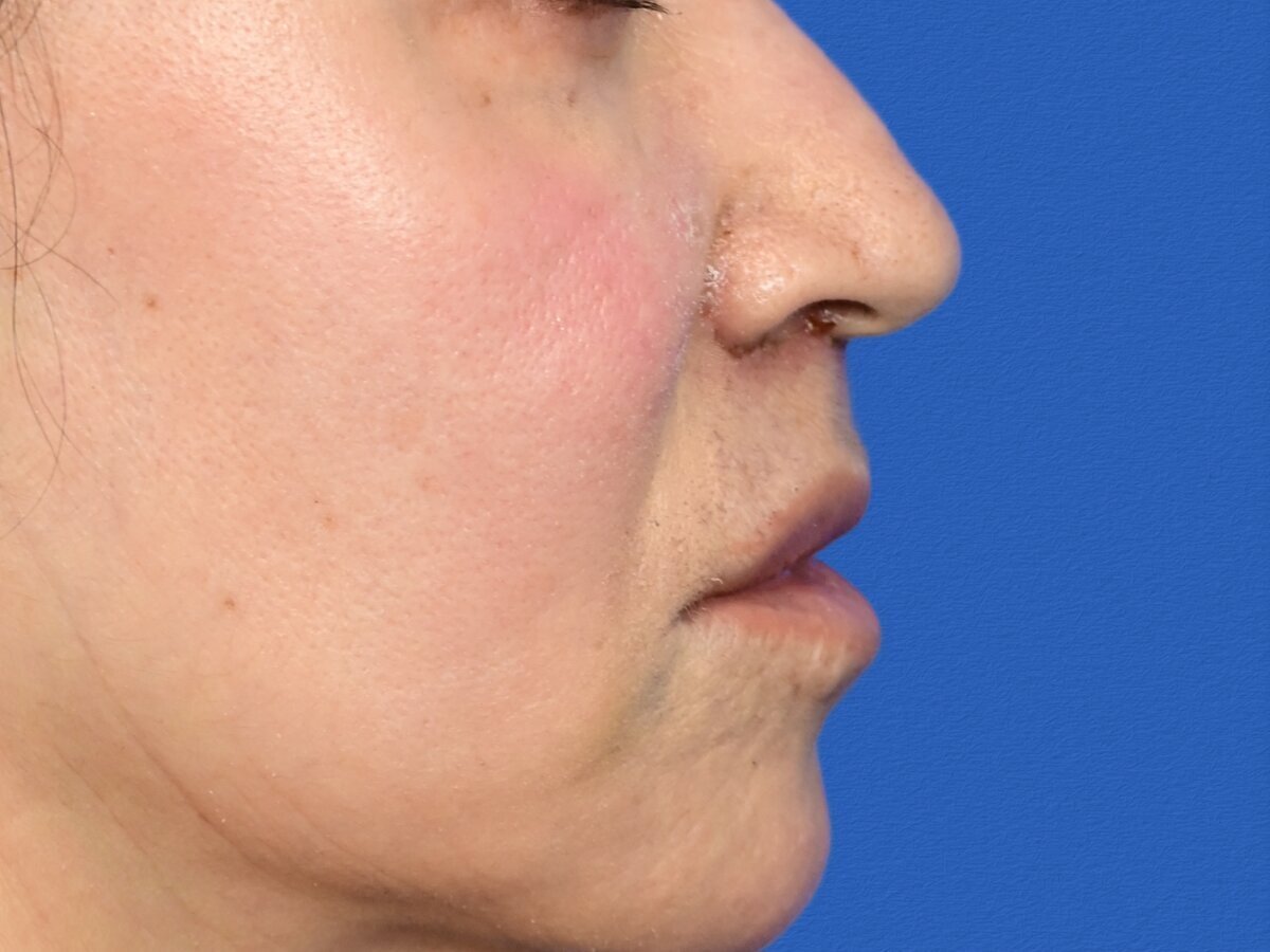 Lip Lift Before & After Image