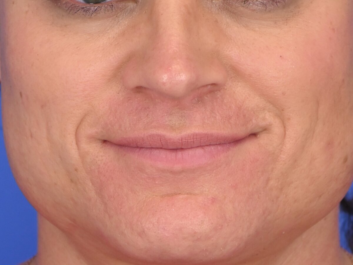 Lip Lift Before & After Image