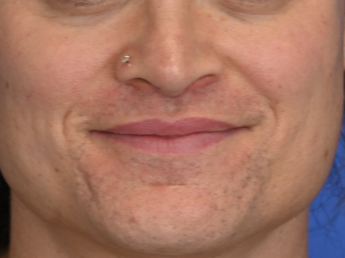 Lip Lift Before & After Image