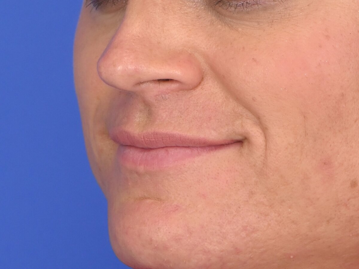Lip Lift Before & After Image