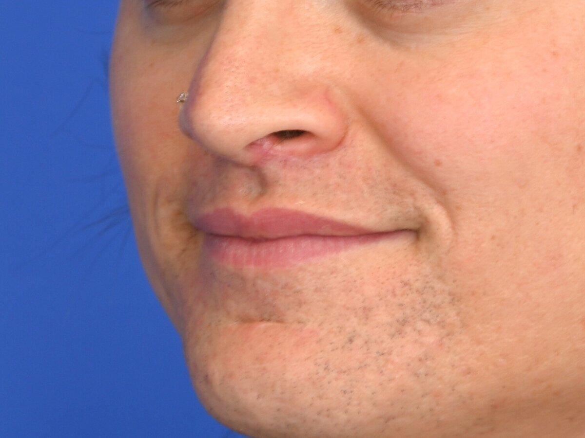 Lip Lift Before & After Image