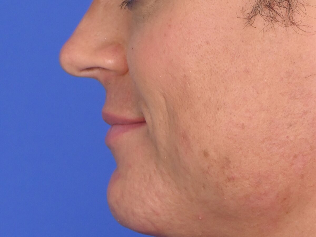 Lip Lift Before & After Image