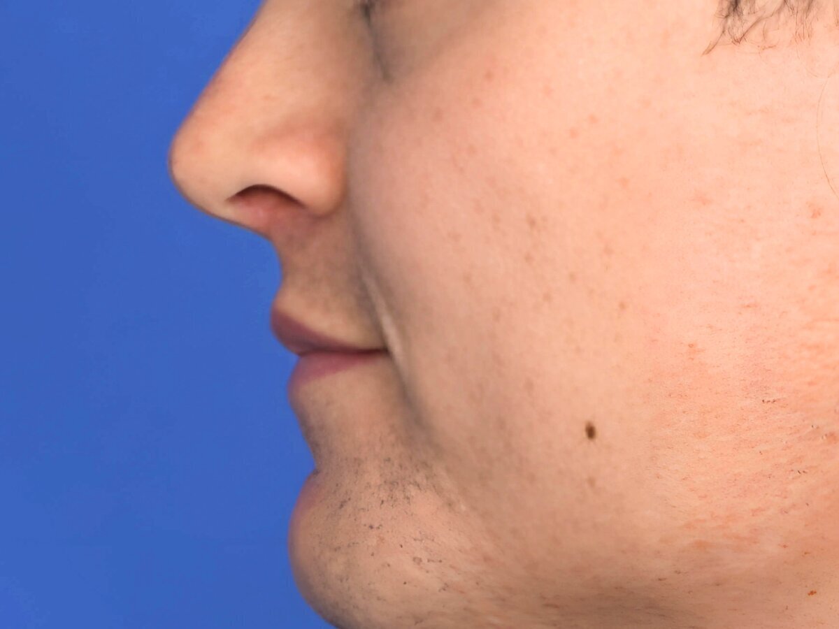 Lip Lift Before & After Image