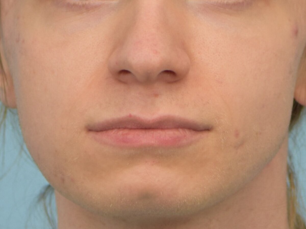 Lip Lift Before & After Image
