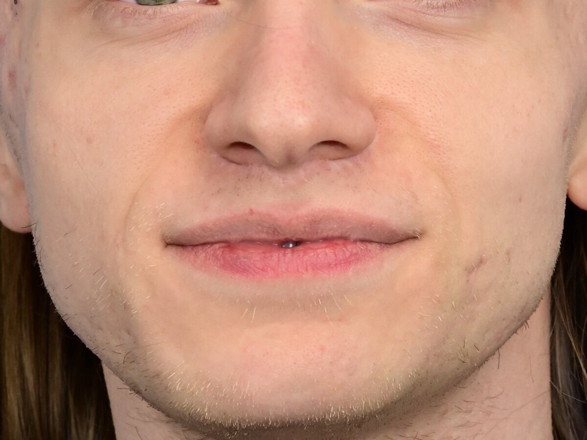 Lip Lift Before & After Image